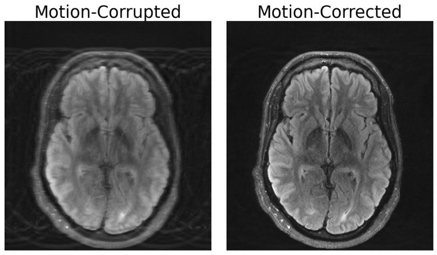 Imagen en la que se compara un cerebro dos veces. En la imagen de la izquierda la RM sale más borrosa mientras que la de la derecha tiene ia y física aplicada en la resonancia magnética y por lo tanto, la imagen sale más nítida.